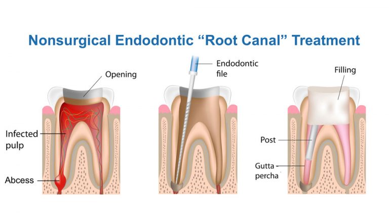 Nonsurgical-Endodontic