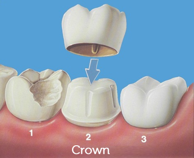 crown