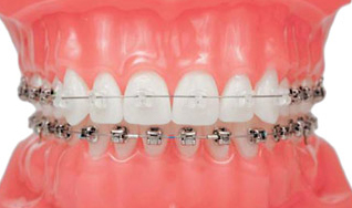 damon-self-ligating-braces