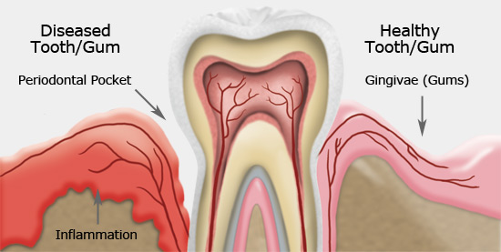 gum_disease