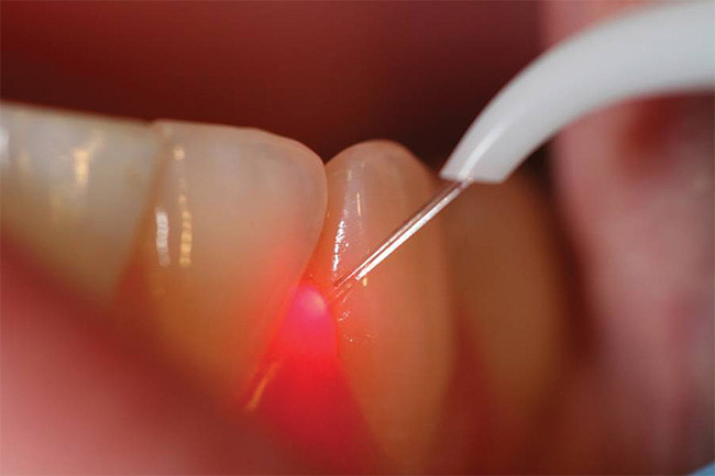 periodontal_laser