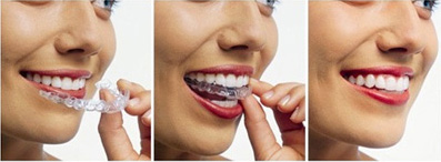 invisalign